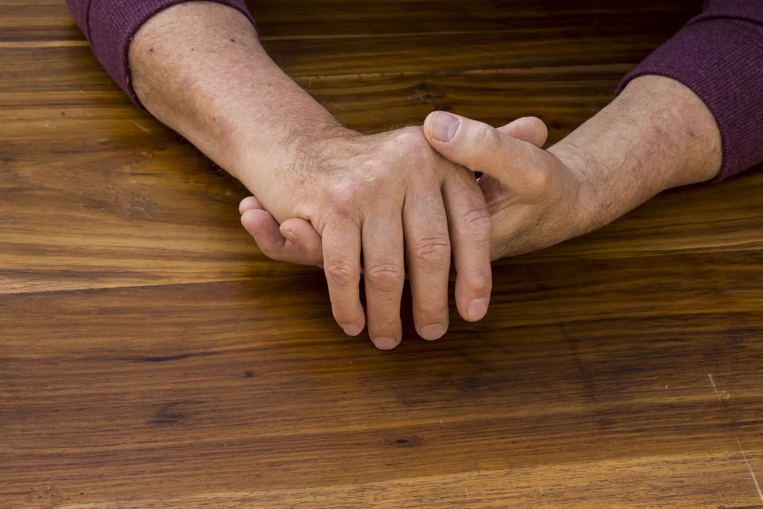 Close-up of hands showing swollen joints and nail pitting typical of psoriatic arthritis.