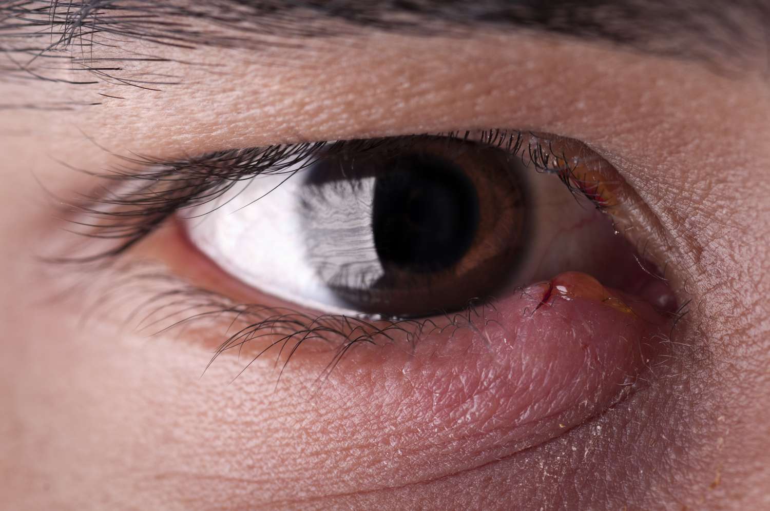 Macro view of an inflamed eyelid bump with significant redness and swelling.