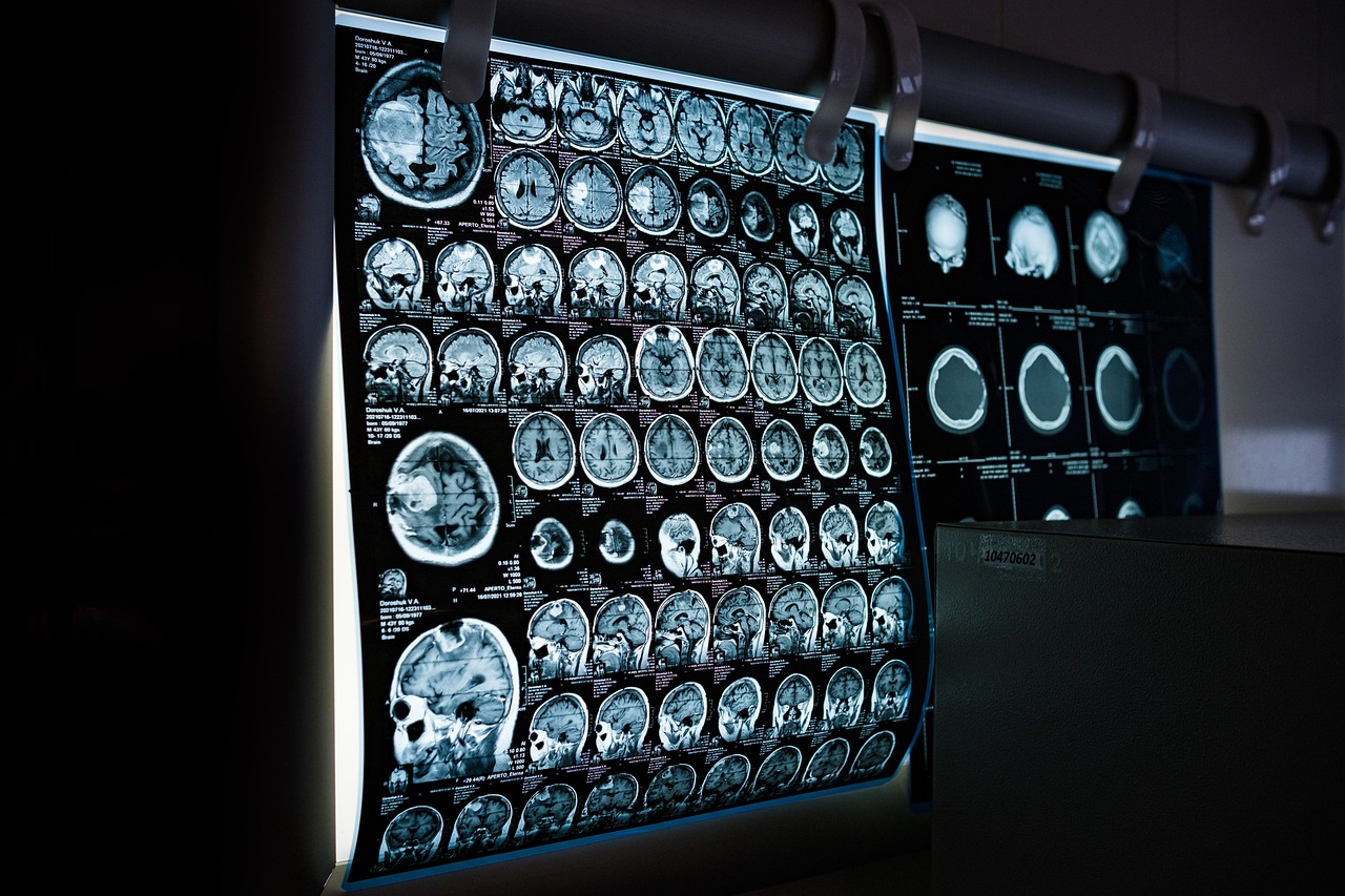 A medical professional looking at a digital brain scan or SPECT imaging interface.