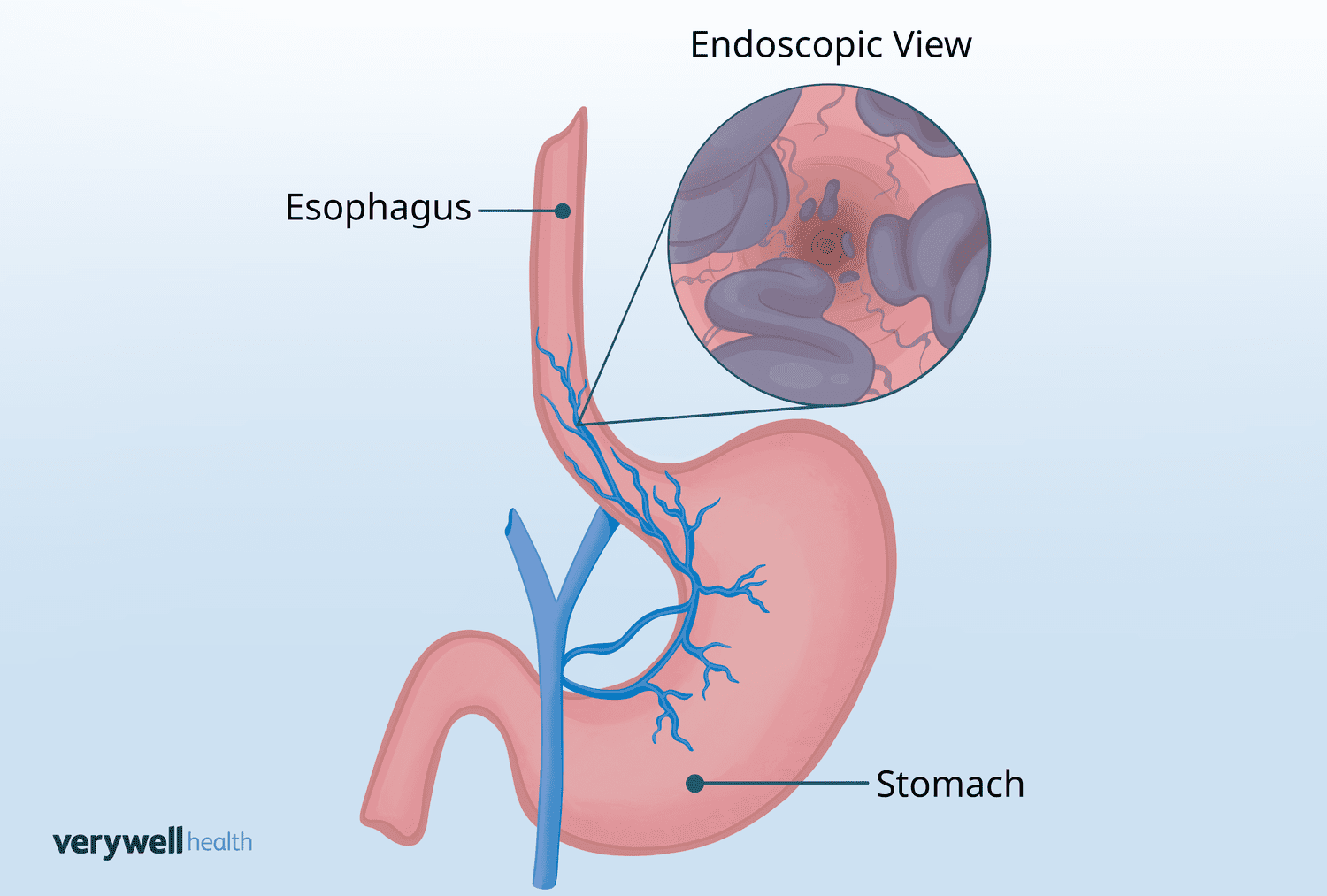 Diagram illustrating the circulatory changes in the portal vein system during hypertension.