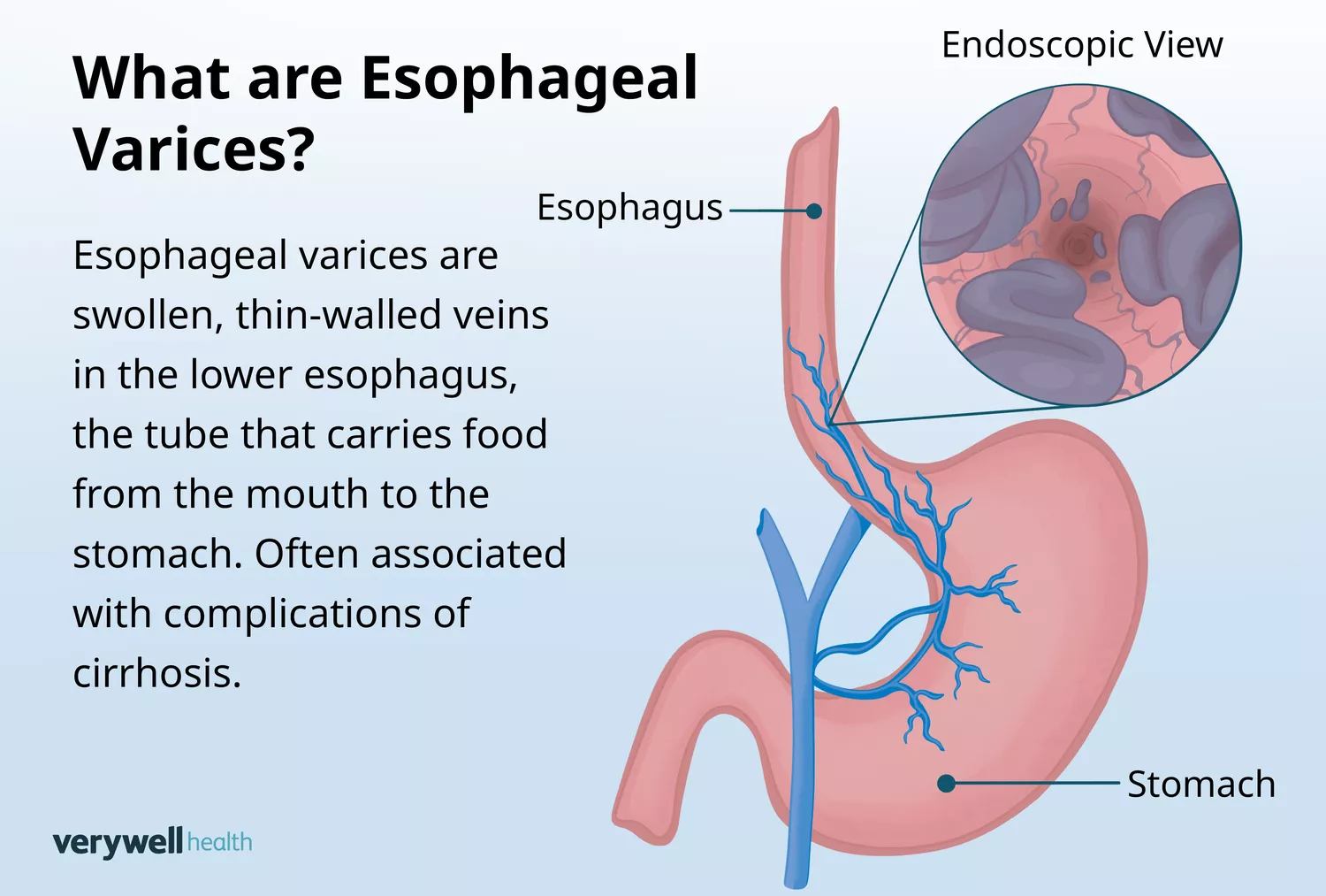 Anatomical illustration showing what esophageal varices look like within the food pipe.