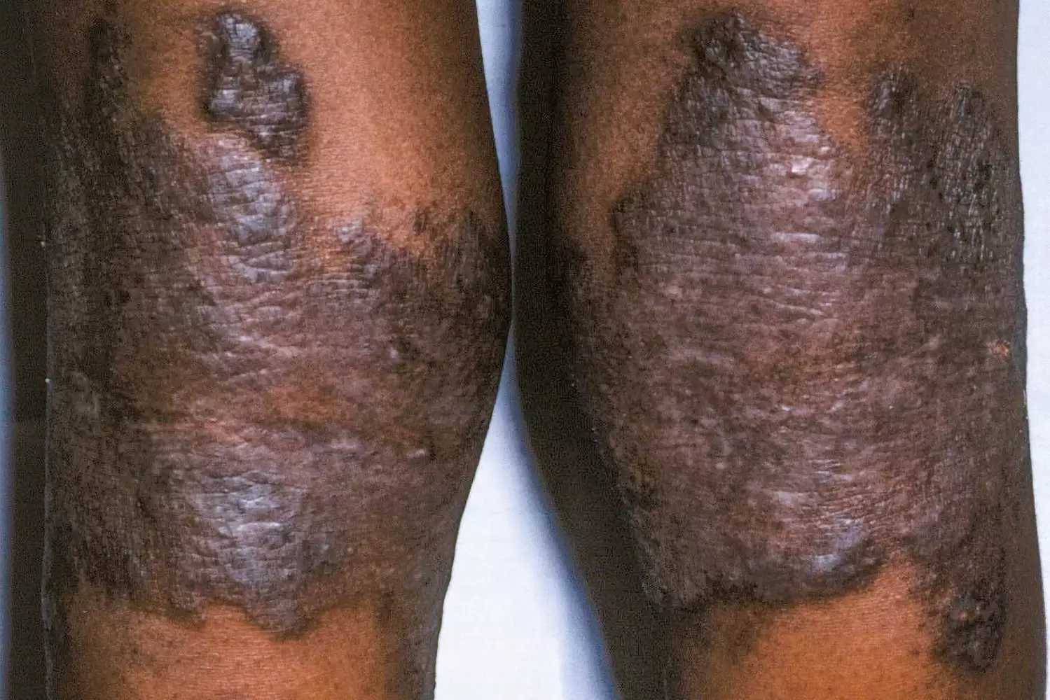 Close-up clinical view of atopic dermatitis showing red, inflamed, and thickened skin texture.