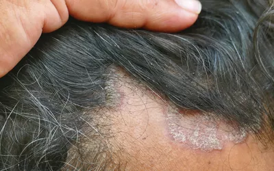 Close-up view of a person's scalp showing inflamed skin, silver scales, and thinning hair.
