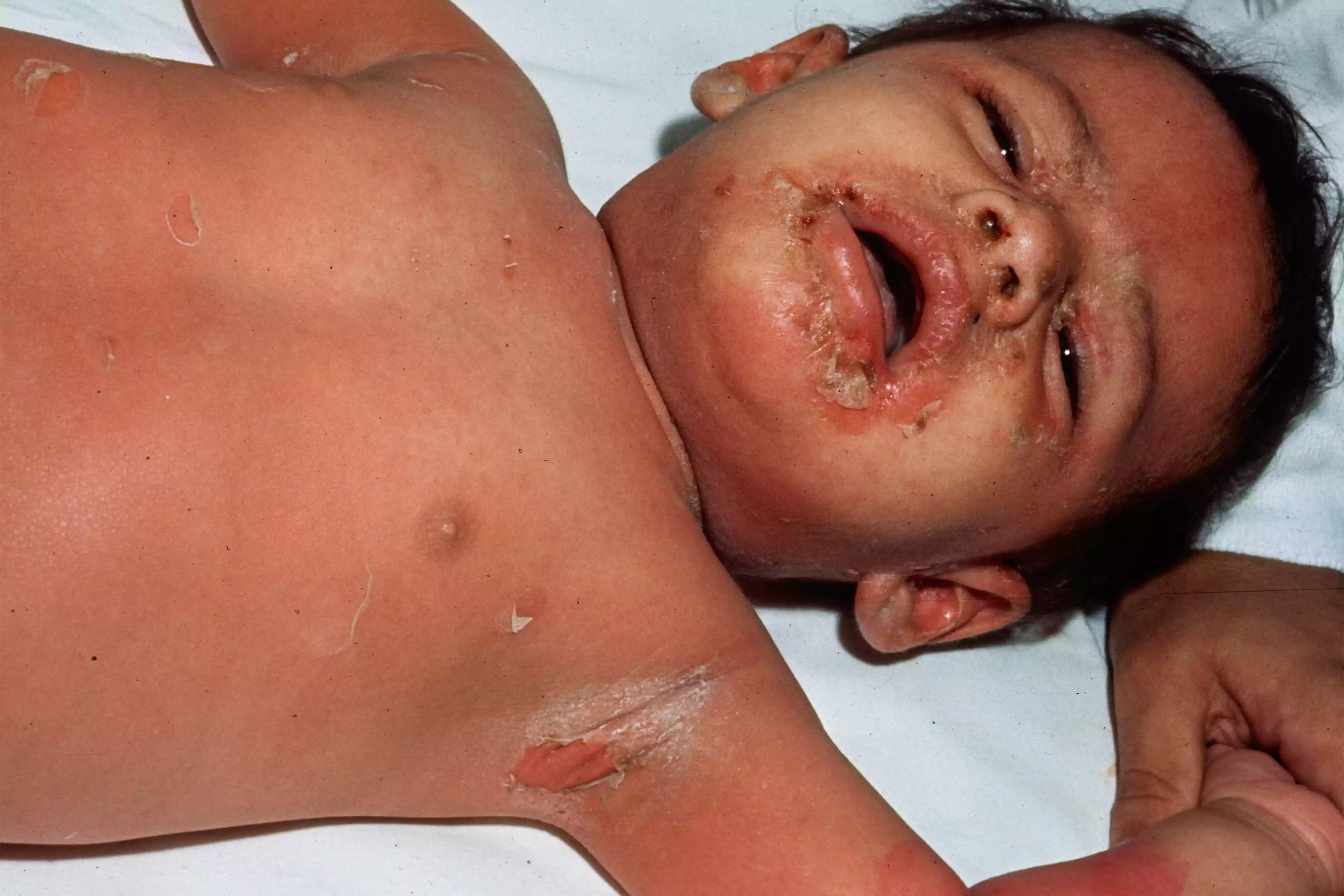 A newborn baby showing widespread erythema and skin peeling on the torso and face due to SSSS.