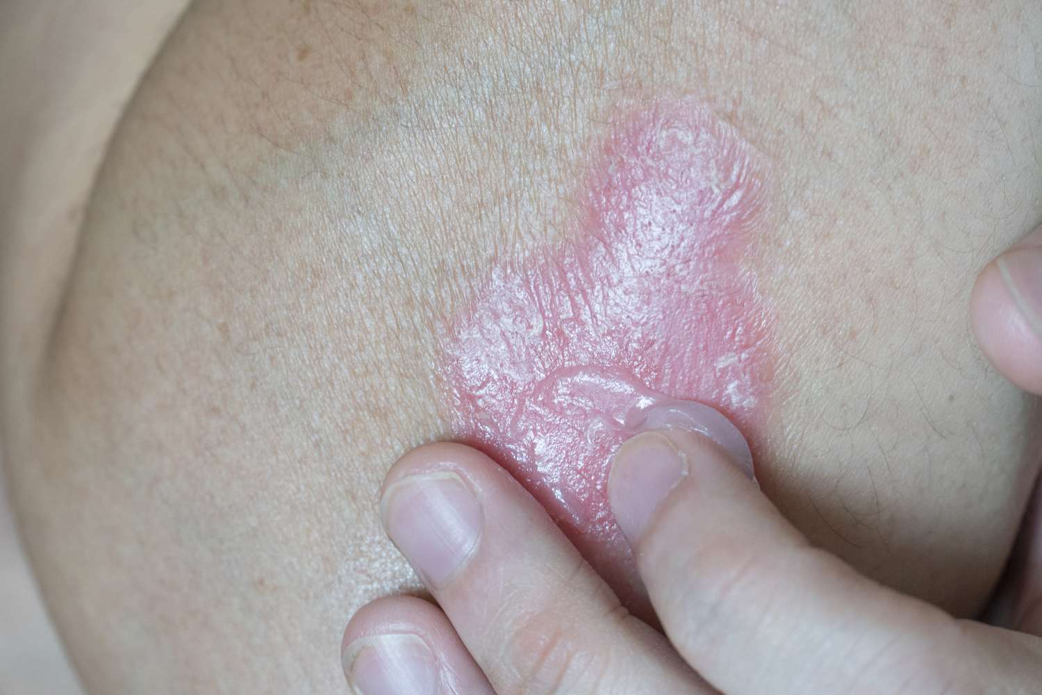 Close-up of a person applying white topical cream to an inflamed red skin patch on their arm.