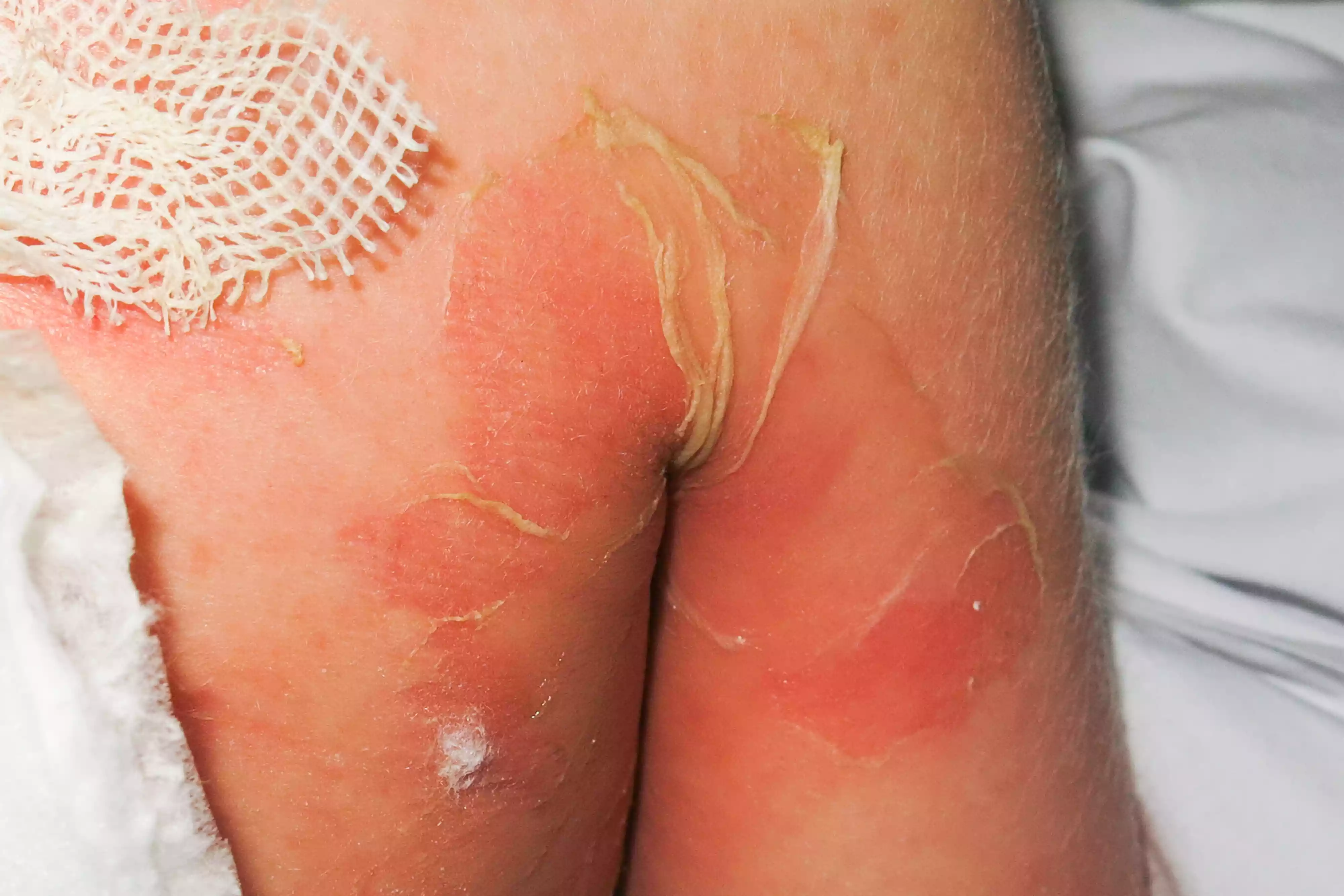 Close-up of peeling skin on a patient's limb with a medical dressing applied to the affected area.