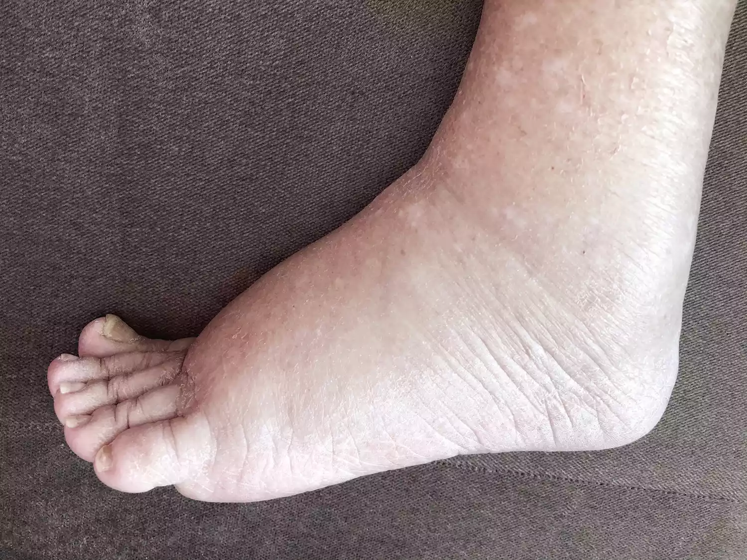 Close-up of foot swelling (edema) which is a common sign of water retention.