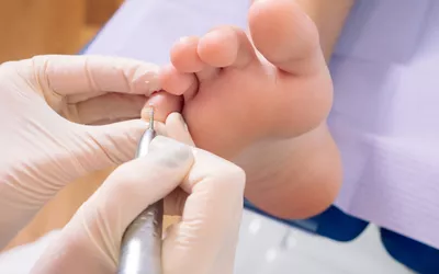 A podiatrist using a professional tool to treat a patient's foot in a clinic.