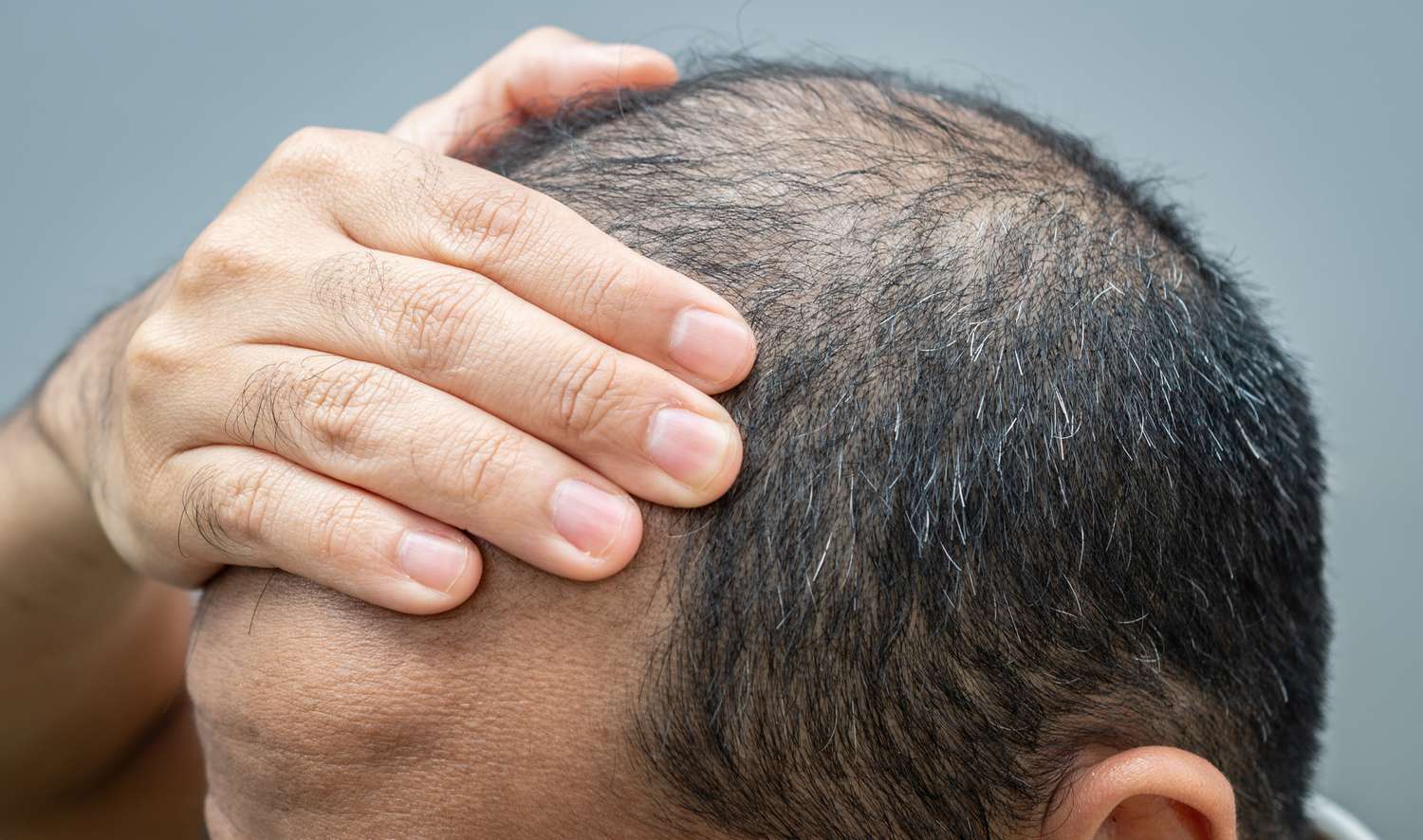 A person checking their scalp for signs of thinning hair or alopecia.