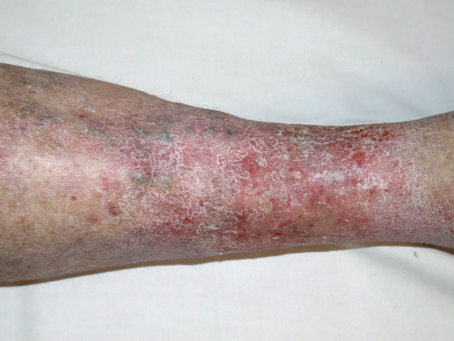 A person with stasis dermatitis on their lower leg skin showing characteristic redness and scaling.